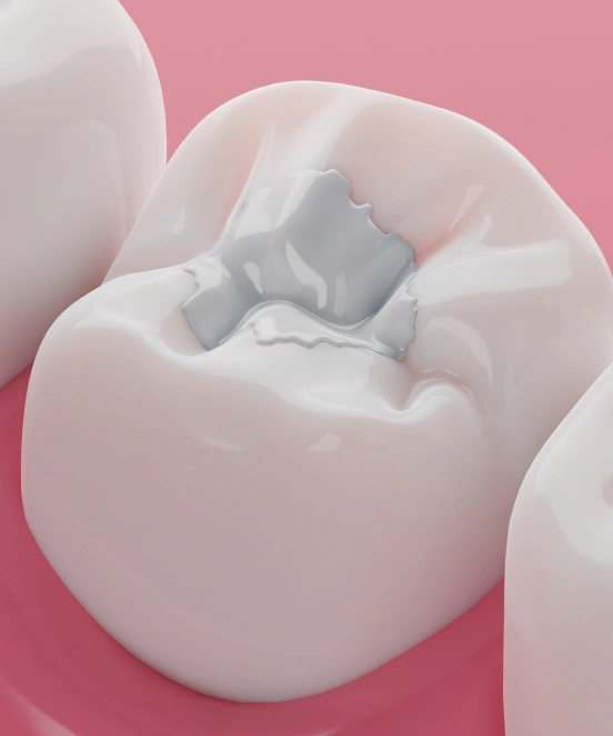Tooth restored with a natural-looking tooth-colored filling