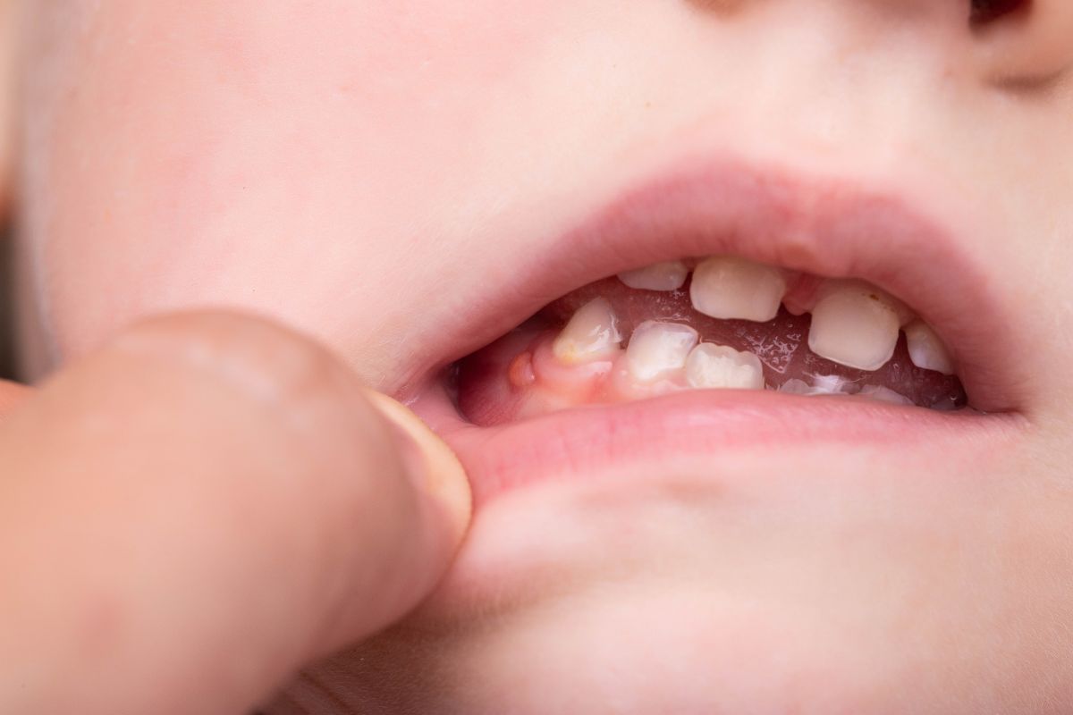 Swollen Gums or Bumps in Children
