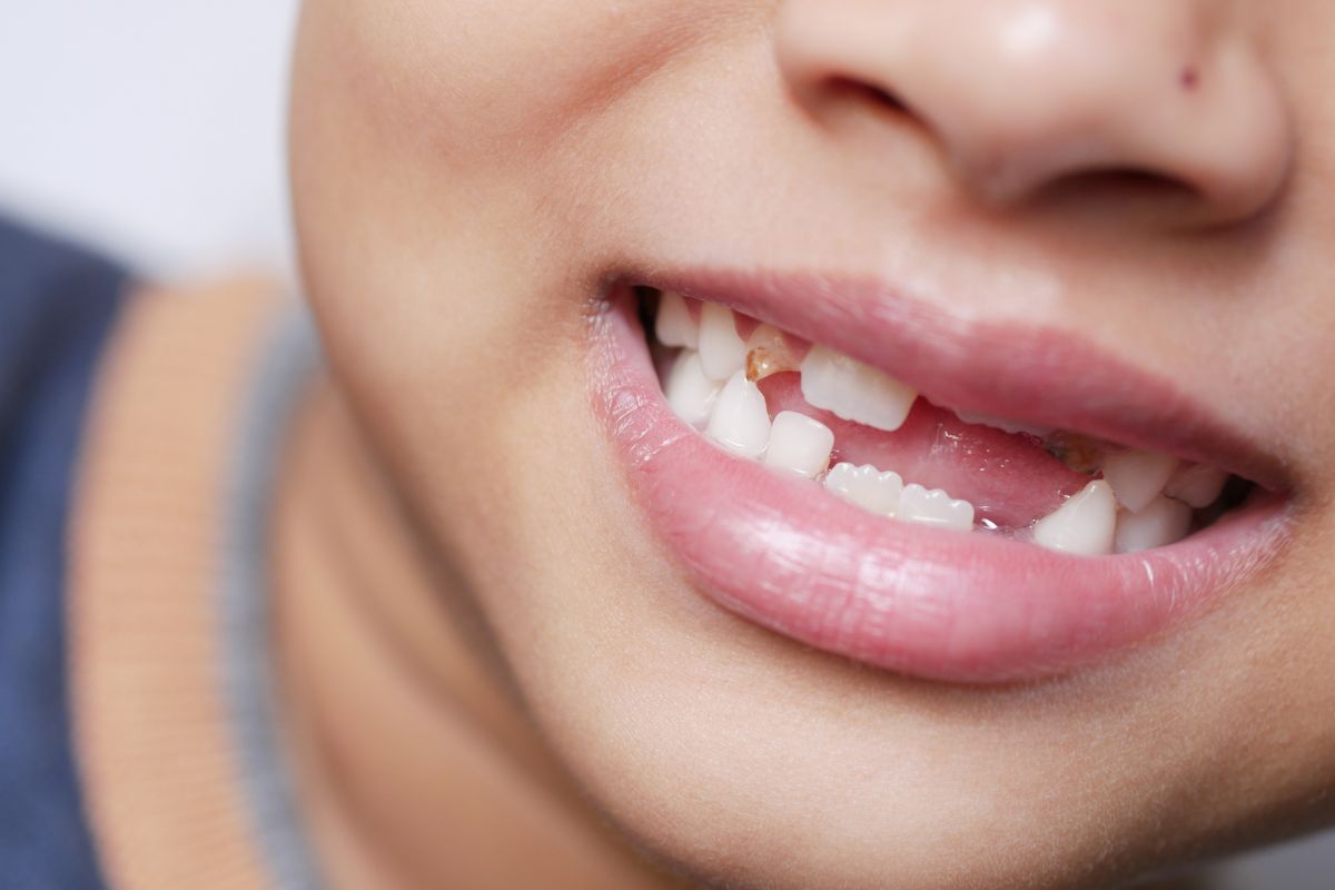 Child Knocks Out Tooth